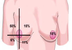 Kanceri i gjirit mund të zhvillohet në të gjithë shtrirjen e tij